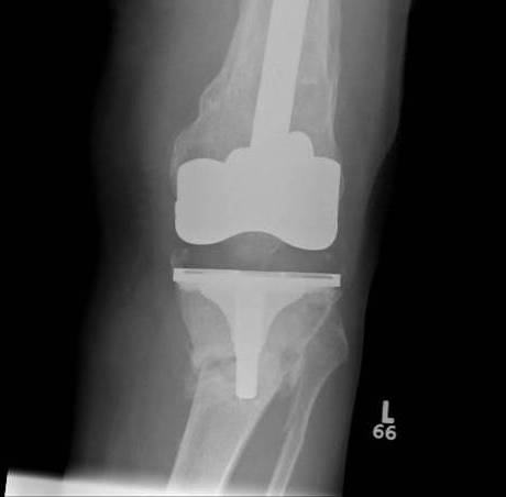 Periprosthetic TKR Tibial Fracture 1